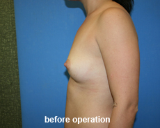 plastic-surgery-breast-augmentation